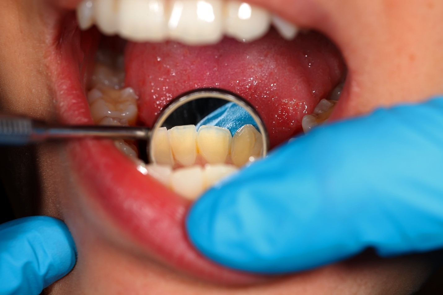 Apakah Karang Gigi Menyebabkan Bau Mulut? Temukan Jawabannya di Sini!